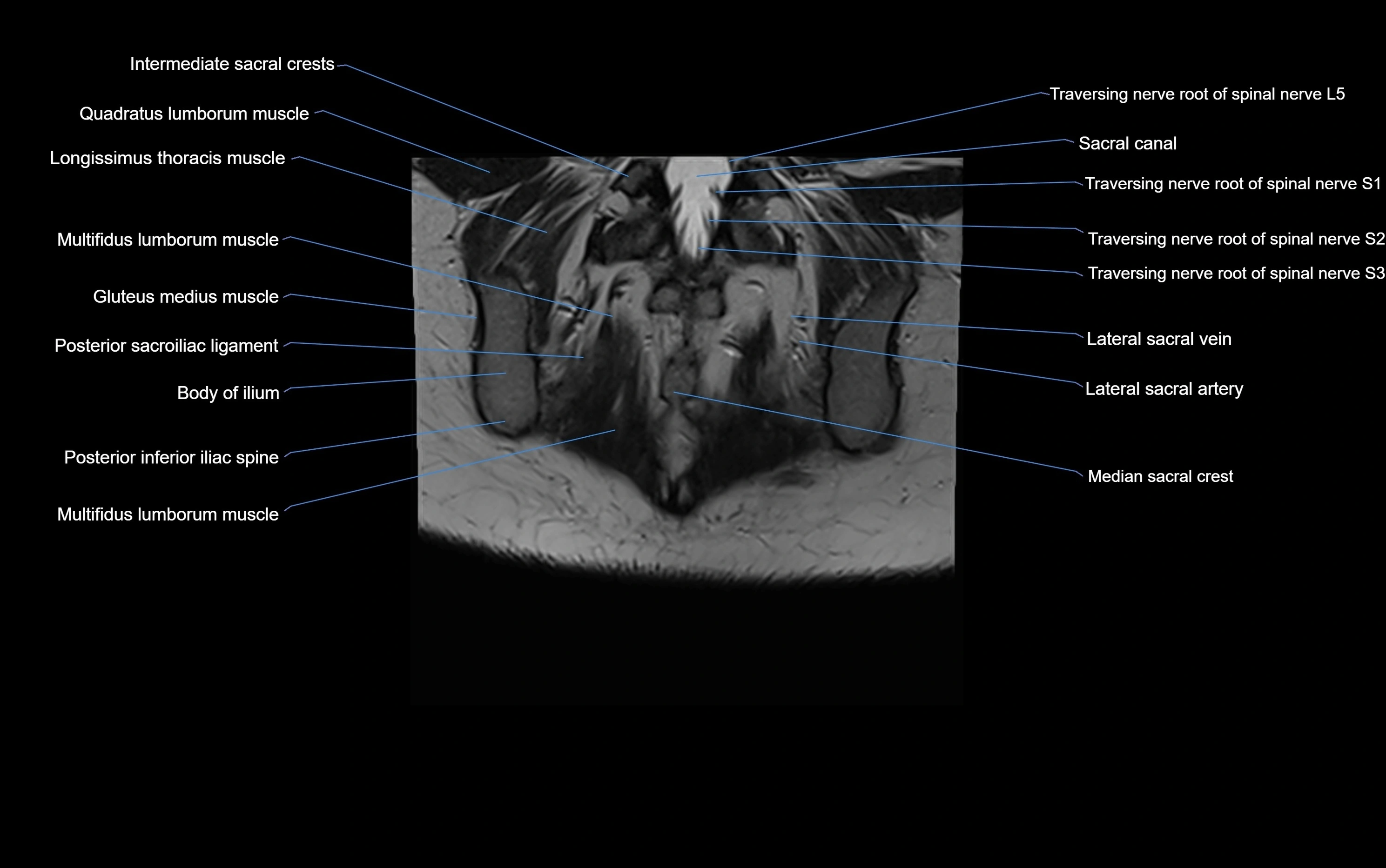 MRI sacroiliac joint coronal cross sectional anatomy  radiology  image-img-00001-00027.webp